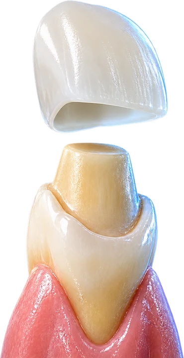 Mão sứ và răng được chuẩn bị theo thiết kế phục hình