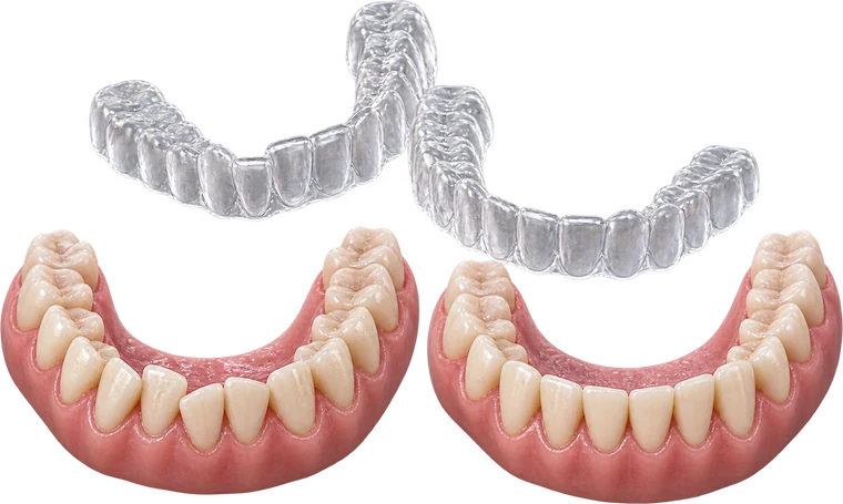Điều trị niềng răng trong suốt tại Nha khoa Việt Hàn