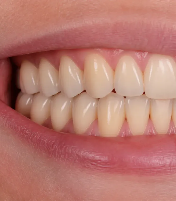 Ảnh sau điều trị – Phục hồi Implant