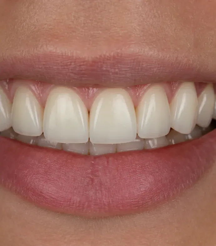 Ảnh sau điều trị – Phục hình thẩm mỹ