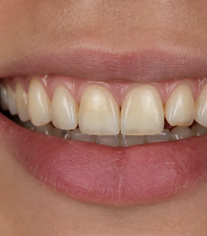 Ảnh trước điều trị – Phục hình thẩm mỹ