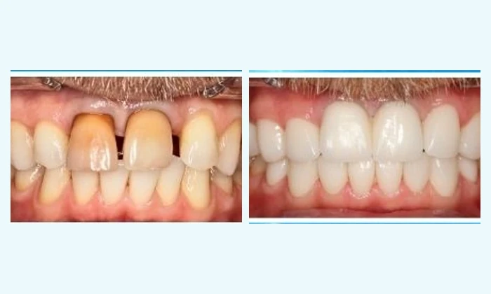 Hình ảnh trước và sau phục hình răng sứ thực tế tại Nha khoa Việt Hàn