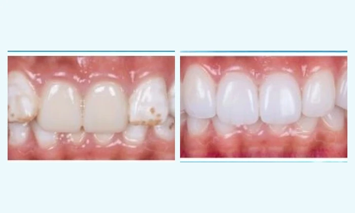 Hình ảnh trước và sau mặt dán sứ Veneer thực tế tại Nha khoa Việt Hàn