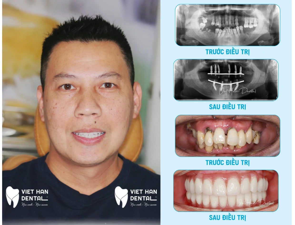 Khách hàng Phạm Vũ và hình ảnh trước sau điều trị Implant toàn hàm
