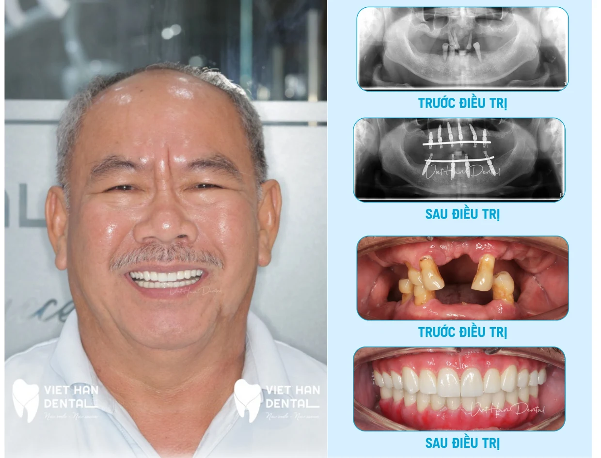 Khách hàng Trần Quốc Sử và hình ảnh trước sau điều trị Implant toàn hàm