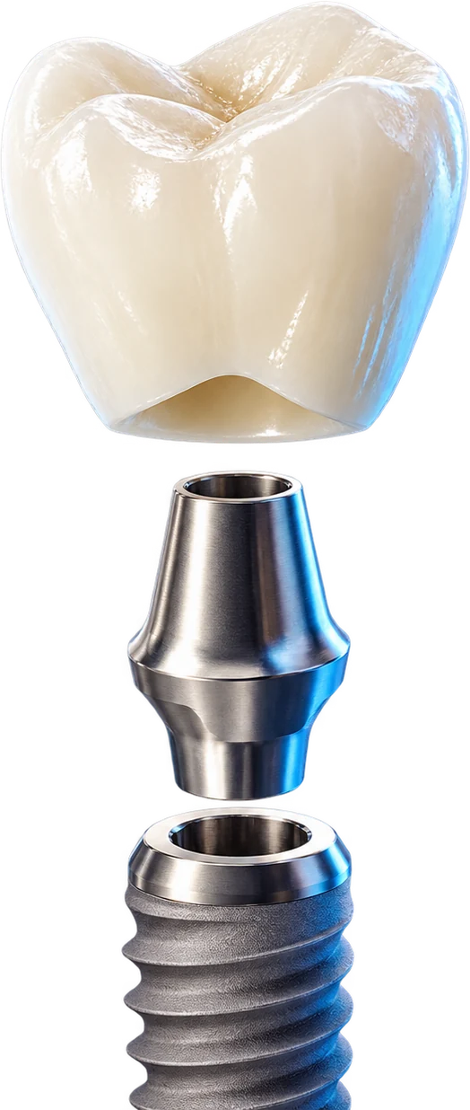Minh họa mão răng sứ kết nối với Abutment và trụ Implant