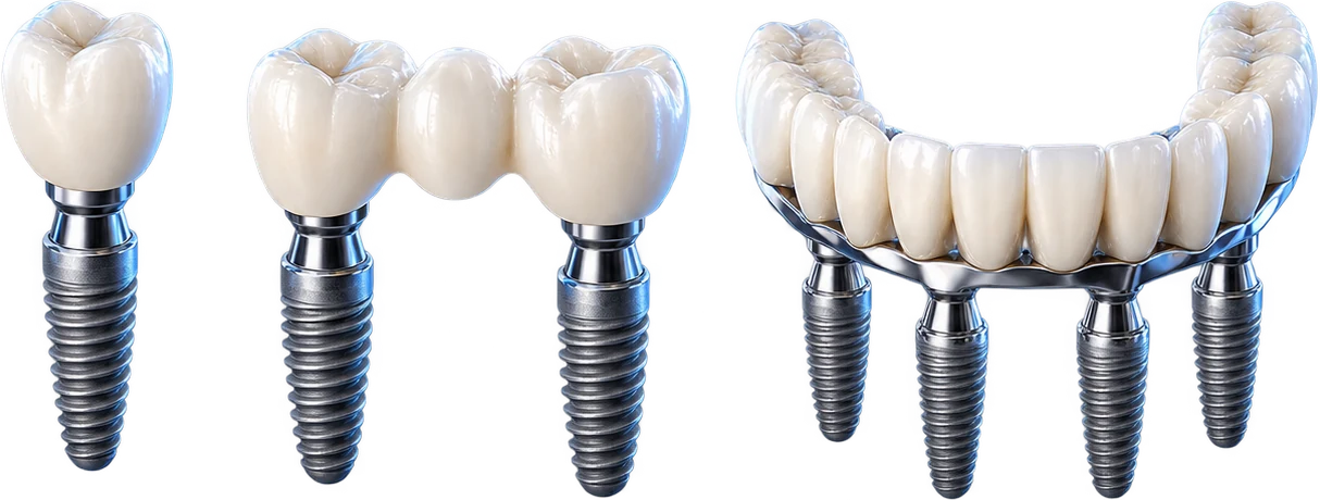 Minh họa các phương án Implant một răng, nhiều răng và toàn hàm