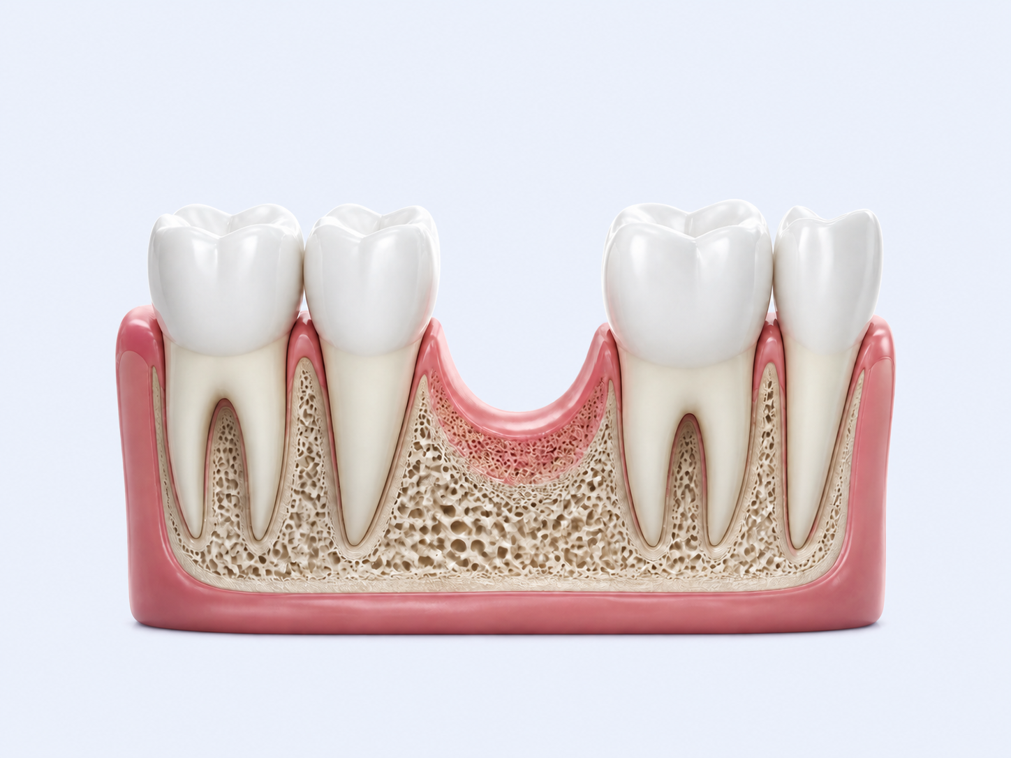 Minh họa muốn phục hình cố định