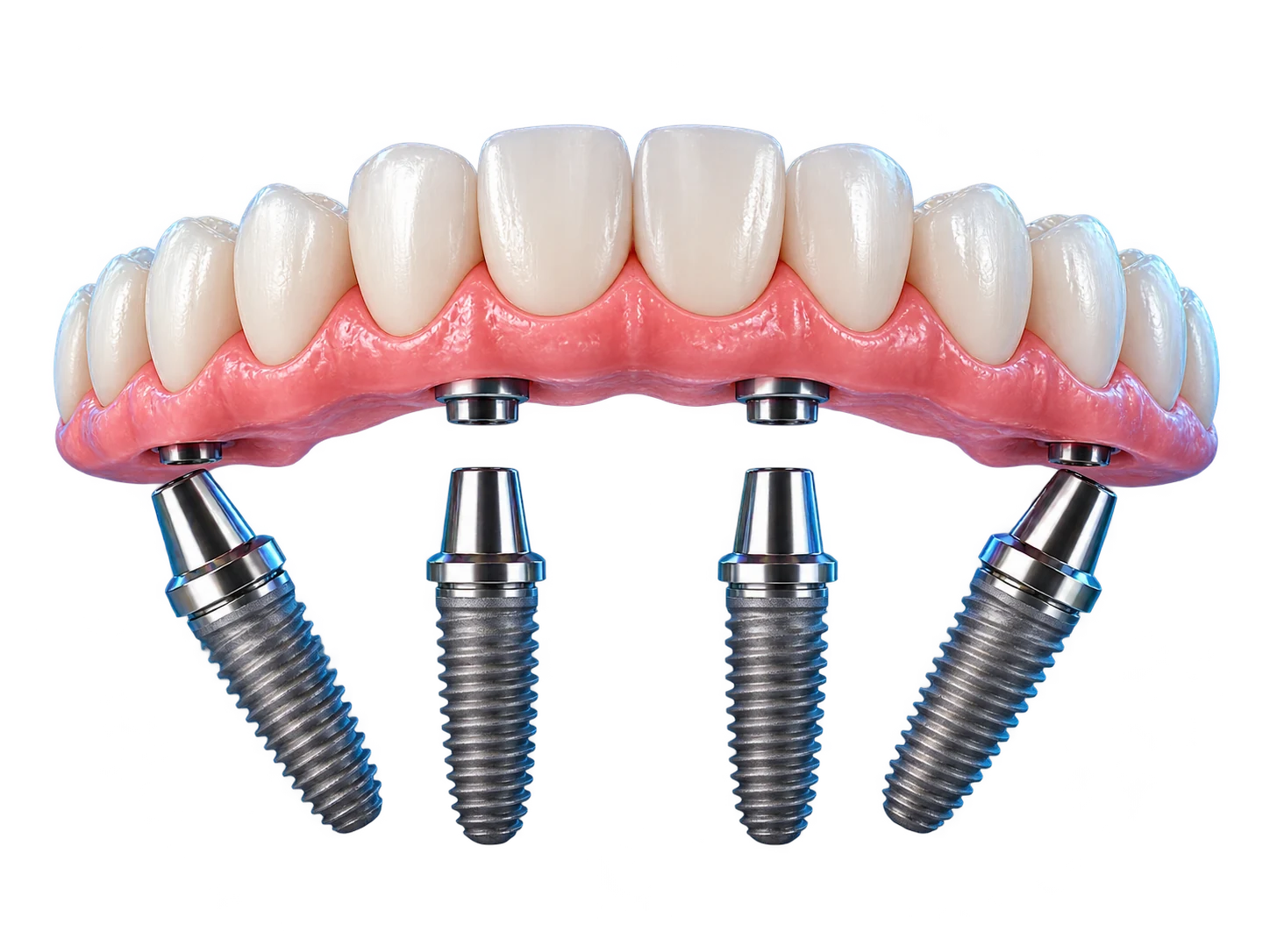 Minh họa cầu răng toàn hàm Implant All-on-4 trên bốn trụ Titanium