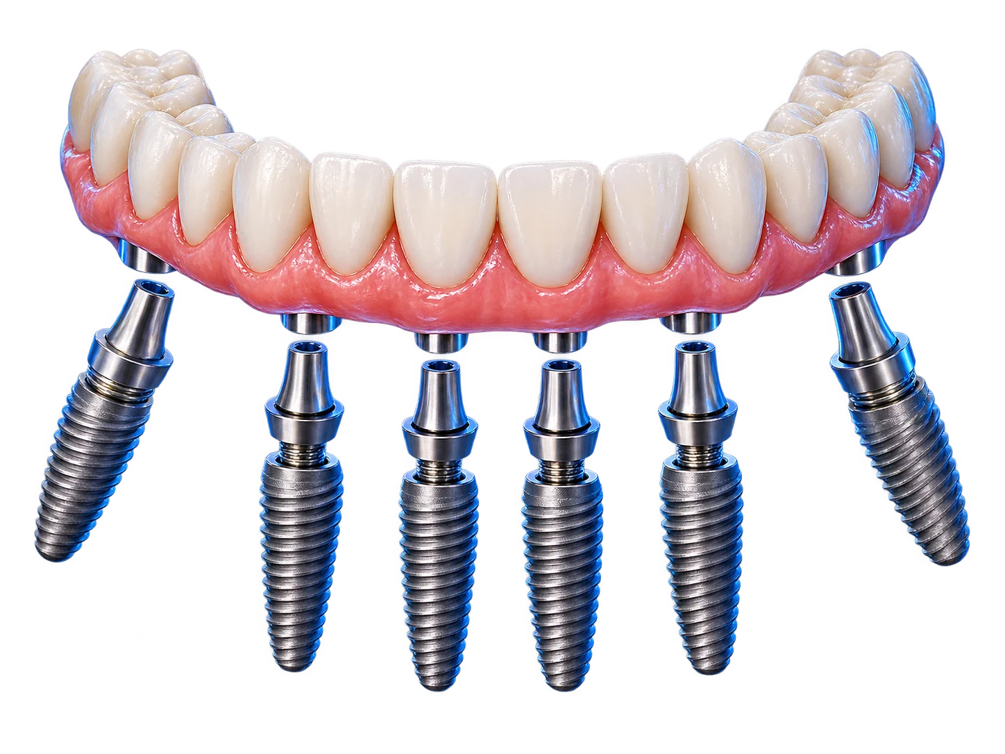 Minh họa cầu răng toàn hàm Implant All-on-6 trên sáu trụ Titanium