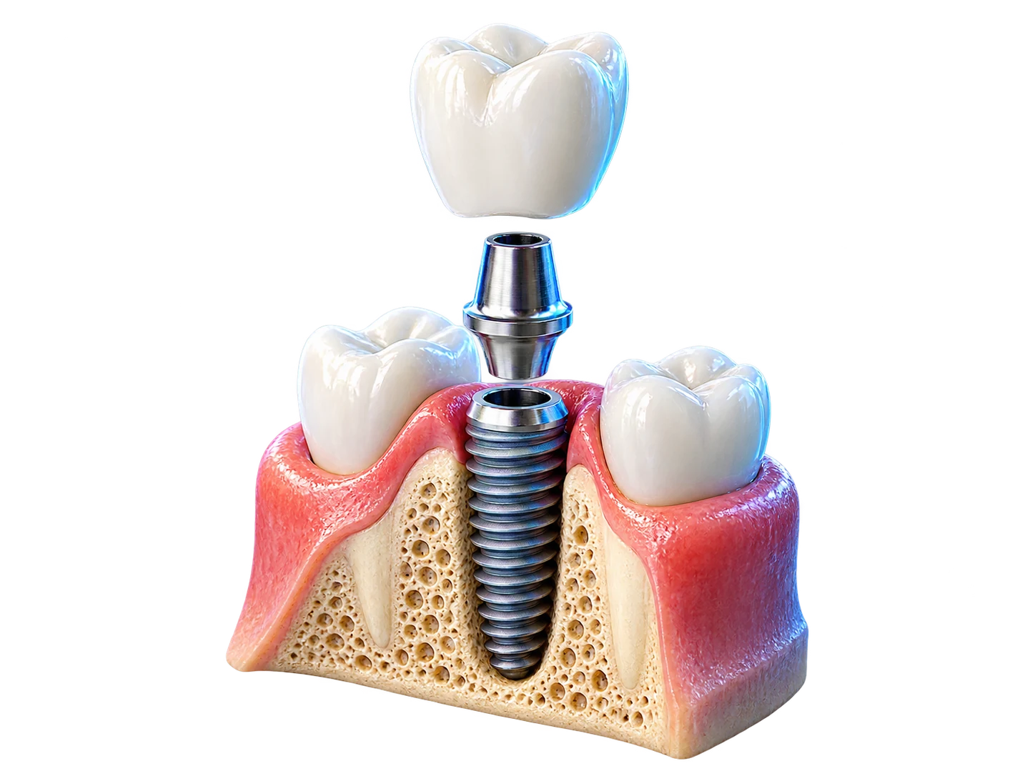 Minh họa cấu tạo một răng Implant đơn lẻ trong xương hàm