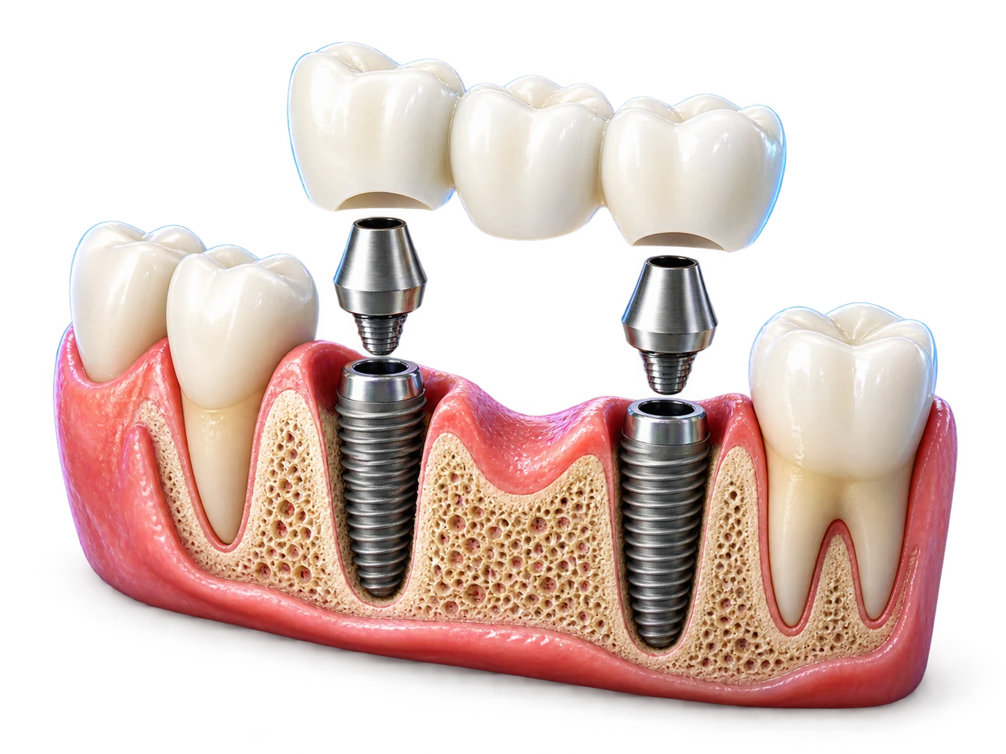 Minh họa cầu ba răng được nâng đỡ trên hai trụ Implant