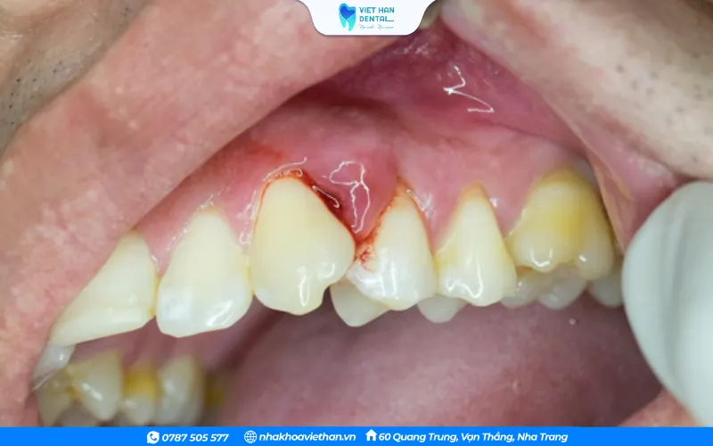 Khi ổ viêm lan rộng, túi mủ sẽ hình thành, gây đau nhức nghiêm trọng và hơi thở có mùi hôi nặng