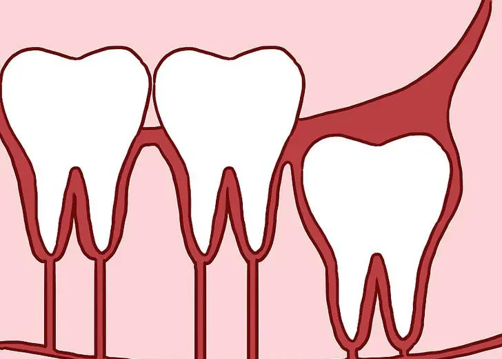 Răng số 8 mọc thẳng 