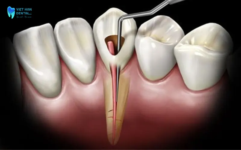 Viêm tủy có hồi phục