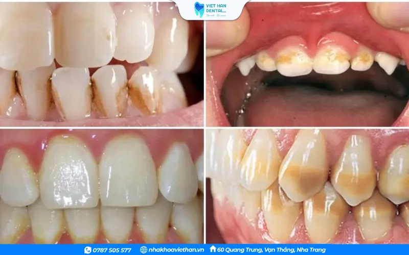Răng xỉn màu lại là vấn đề mà nhiều người đang gặp phải