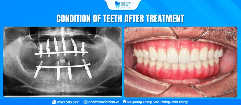 The condition of Mr. Vo Duc Su's teeth after treatment at Viet Han Dental Clinic.