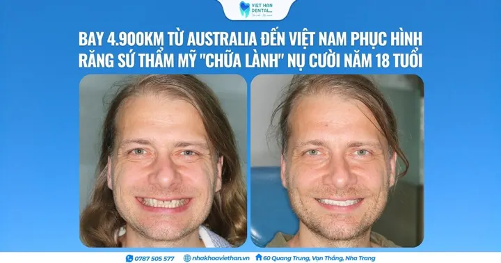 Hành trình bay 4.900km từ Australia đến Việt Nam phục hình răng sứ thẩm mỹ “chữa lành” nụ cười năm 18 tuổi