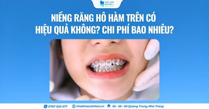 Niềng răng hô hàm trên có hiệu quả không? Chi phí bao nhiêu?