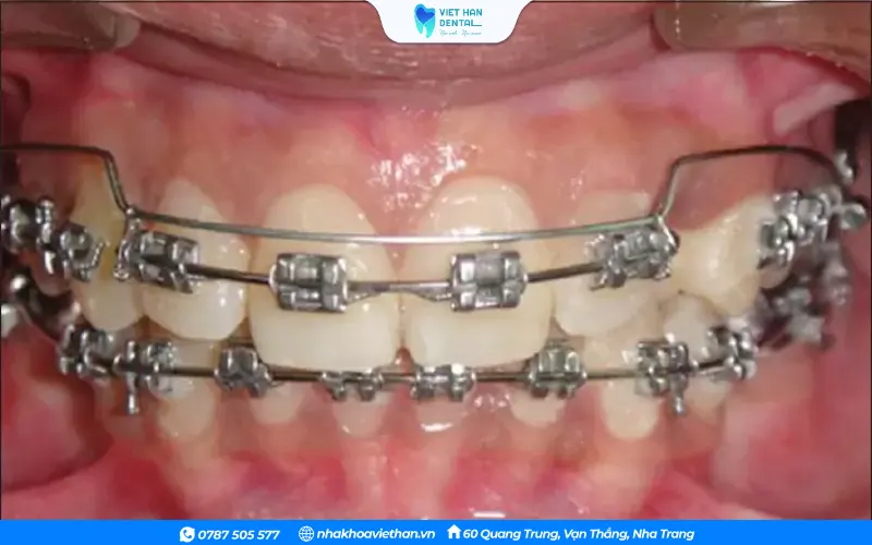 Sử dụng dây cung kim loại tỏng niềng răng
