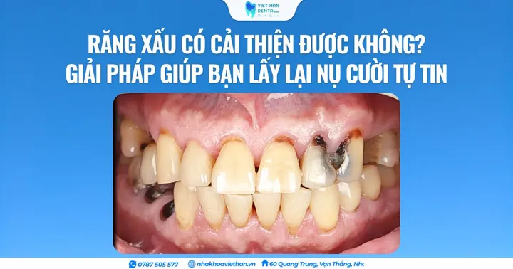 Răng xấu có cải thiện được không? Giải pháp giúp bạn lấy lại nụ cười tự tin