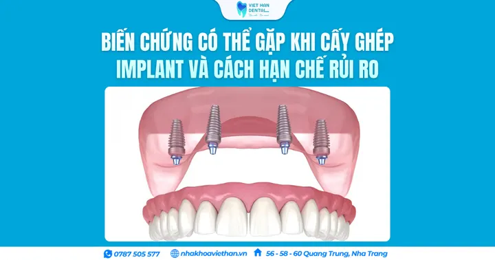 Biến chứng có thể gặp khi cấy ghép Implant và cách hạn chế rủi ro