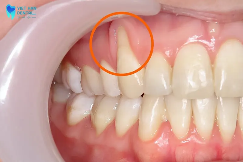 Mô nướu một khi đã bị tổn thương và tụt xuống do các bệnh lý