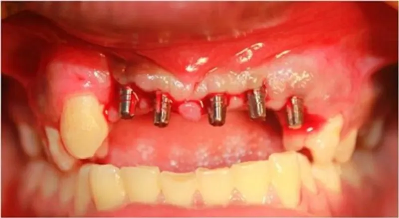Chảy máu sau khi cắm trụ Implant