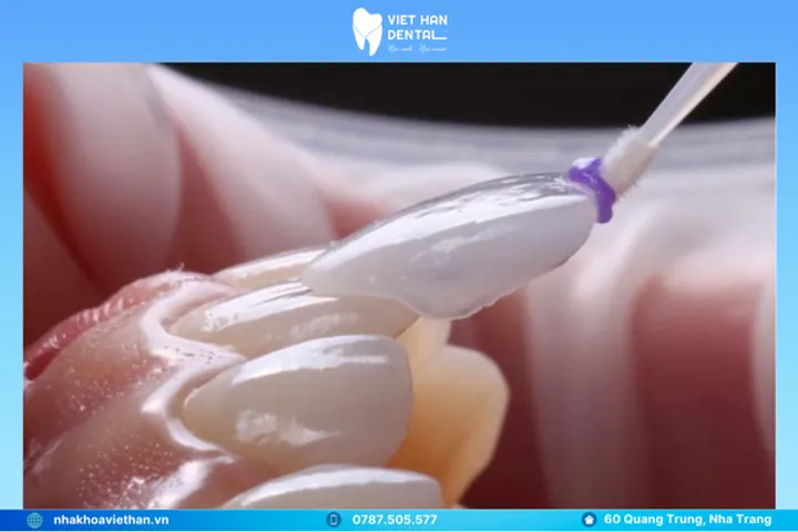 Veneer Emax