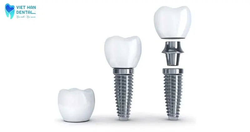 Cấu trúc của một trụ Implant 