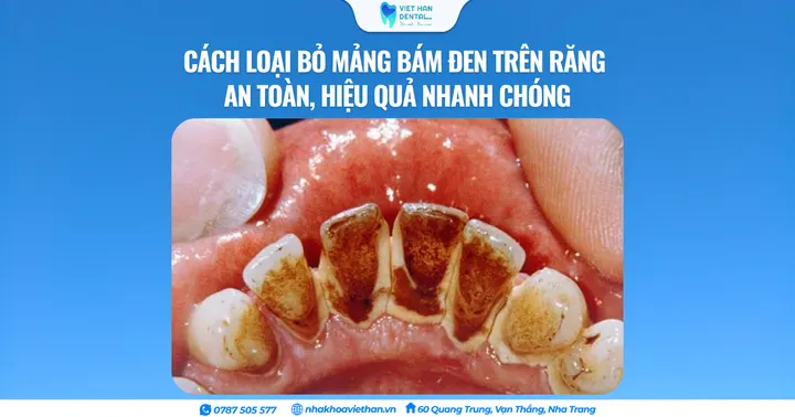Cách loại bỏ mảng bám đen trên răng an toàn, hiệu quả nhanh chóng