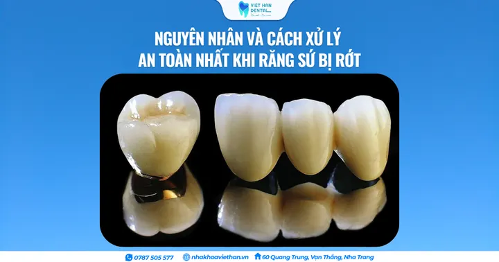 Nguyên nhân và cách xử lý an toàn nhất khi răng sứ bị rớt