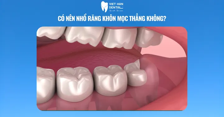 Có nên nhổ răng khôn mọc thẳng 90 độ không?