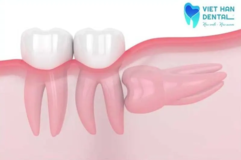 Răng khôn mọc lệch 90 độ