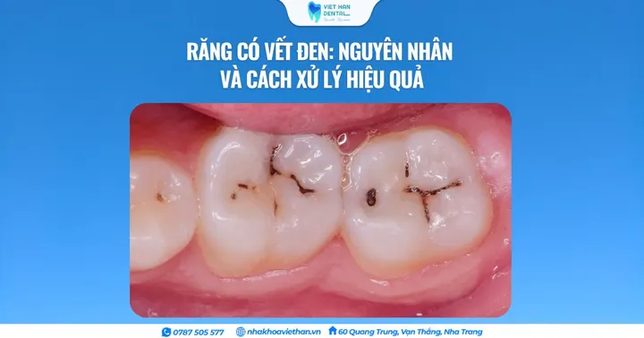 Răng có vết đen: Nguyên nhân và cách xử lý hiệu quả