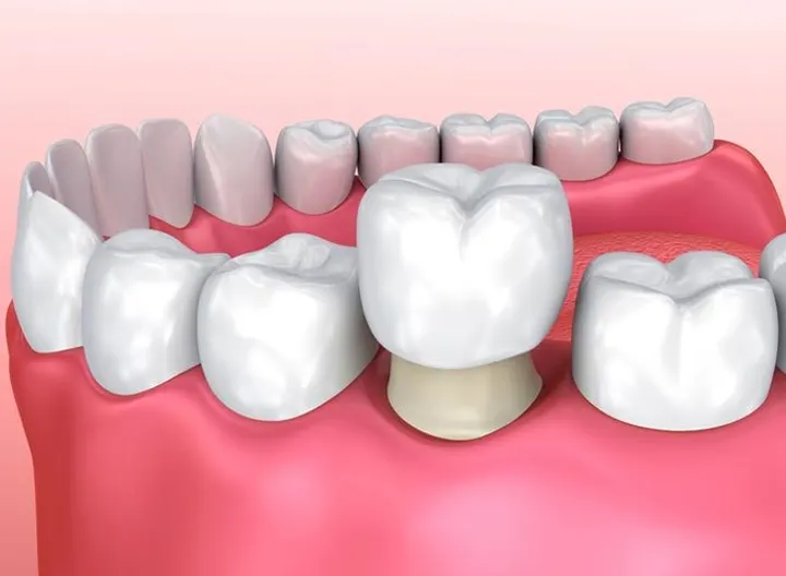 Địa chỉ bọc răng sứ uy tín tại Nha Trang