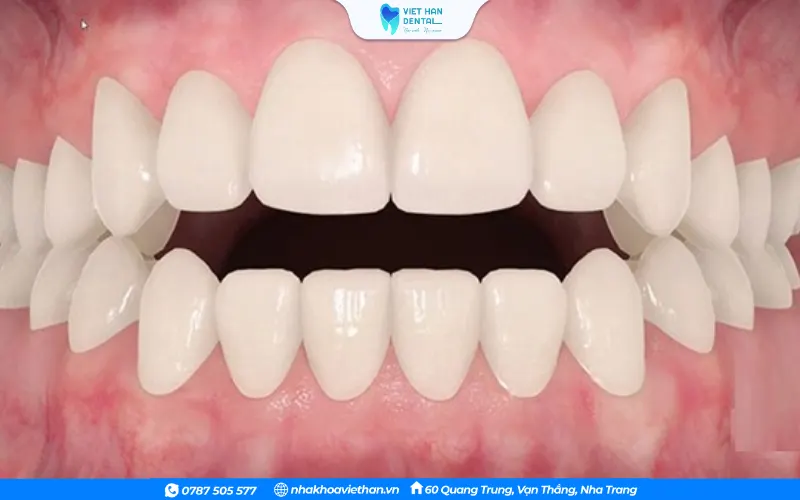 CÓ hàm răng bị khớp cắn hở khiến người bệnh cảm thấy thiếu tự tin