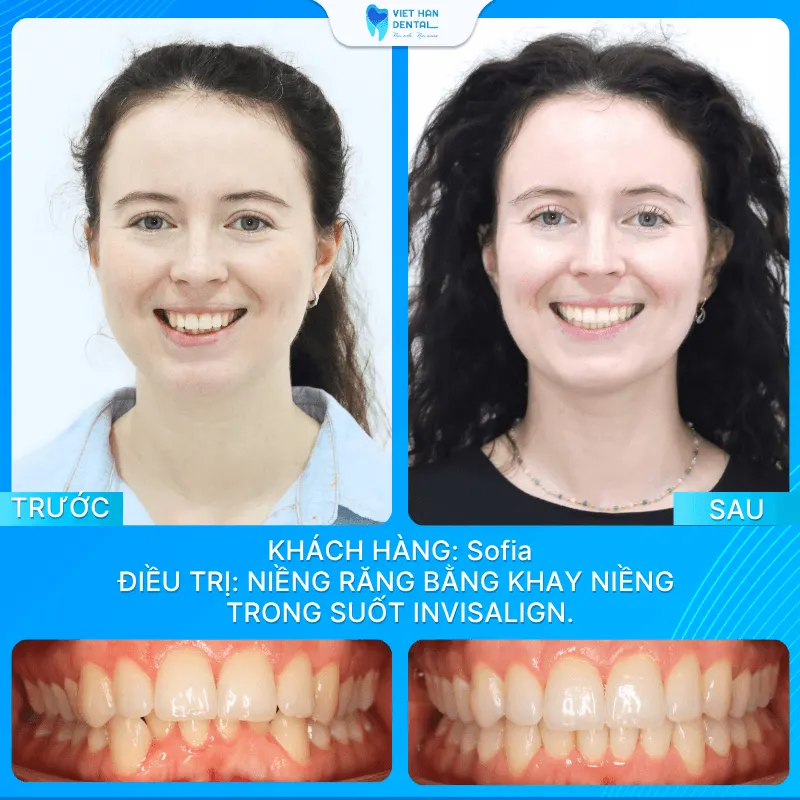 Chị Sofiatrước và sau khi niềng răng trong suốt Invisalign