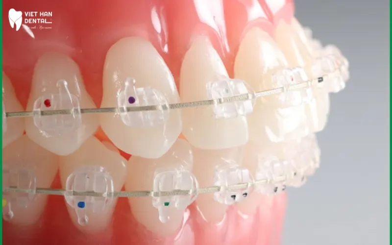 Độ&nbsp; bền của mắc cài sứ có thể lên đến 900Mpa, gấp 5 lần so với răng thật
