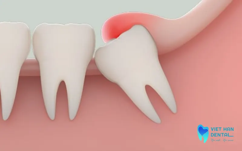 Nhiễm trùng và viêm lợi quanh răng khôn