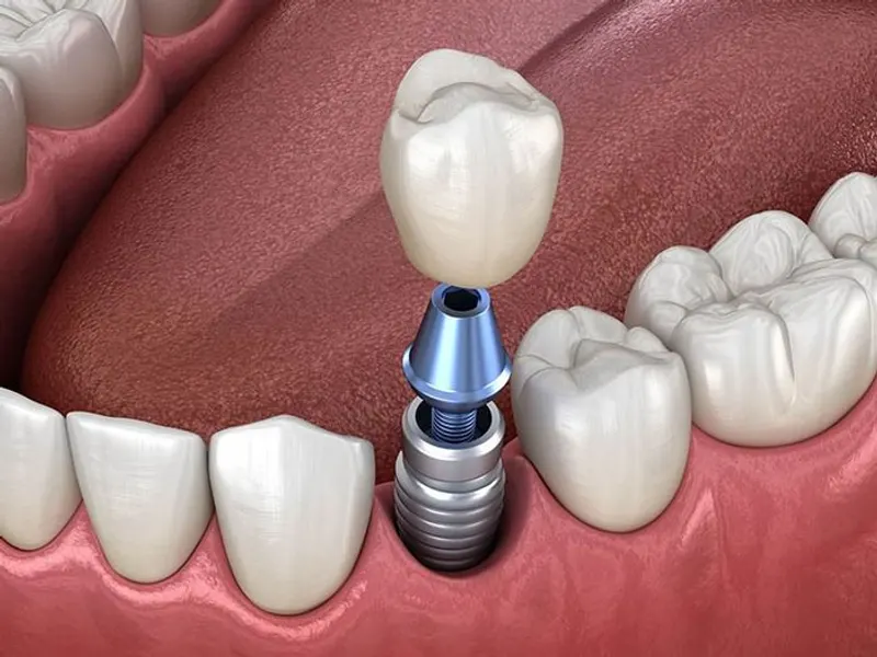 truong-hop-nao-nen-cay-ghep-implant-nha-khoa-viet-han