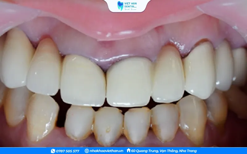 Sử dụng mão sứ hoặc vật liệu gắn kém chất lượng có thể gây kích ứng cho răng và nướu