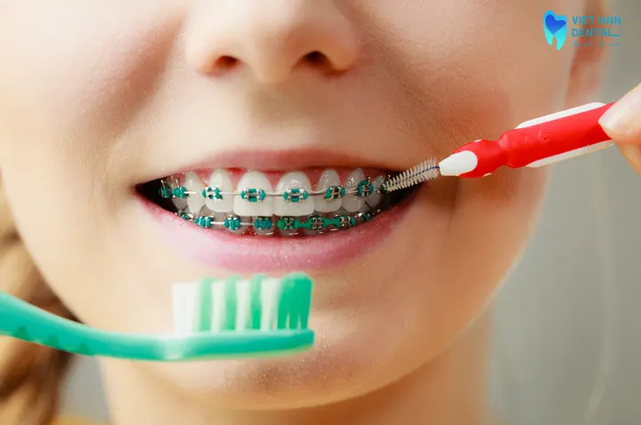 Hướng dẫn cách chăm sóc răng trong quá trình niềng răng