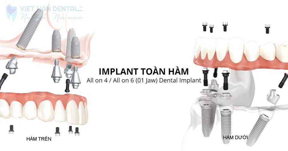 Trồng răng Implant toàn hàm