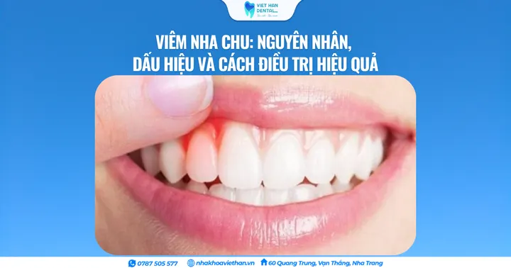 Viêm nha chu: Nguyên nhân, dấu hiệu và cách điều trị hiệu quả
