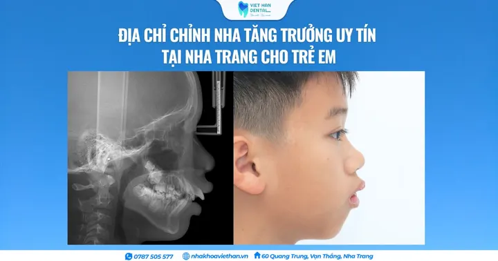 Địa chỉ chỉnh nha tăng trưởng uy tín tại Nha Trang cho trẻ em