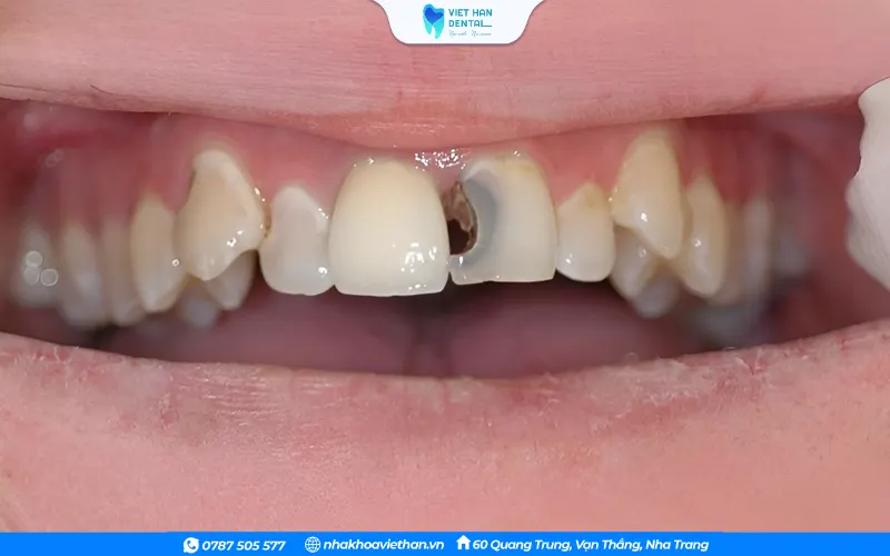 Sâu răng là một trong những nguyên nhân dẫn đến viêm chân răng