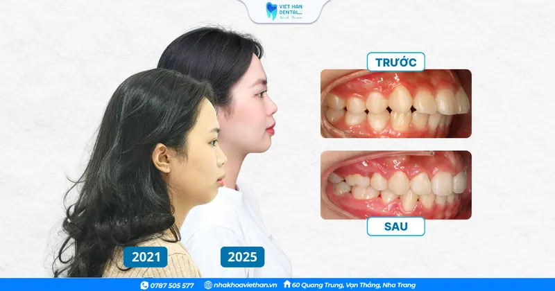 Ages 12–16: the golden period for braces