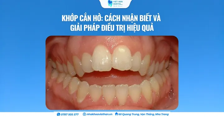 Khớp cắn hở: Cách nhận biết và giải pháp điều trị hiệu quả