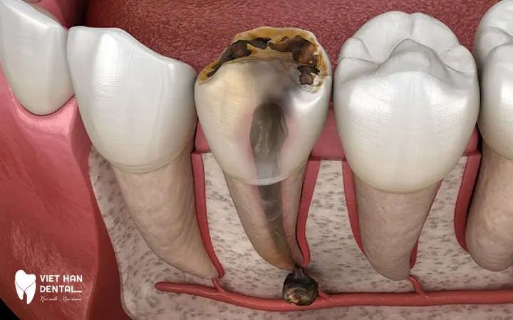 Root Canal Treatment